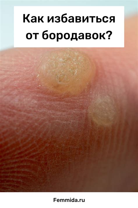 Бородавки: почему появляются и как их лечить? | Себорейный дерматит ...