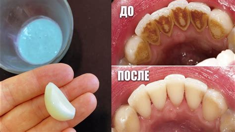 Отбеливание зубов в домашних условиях за 2 минуты. Как естественным ...