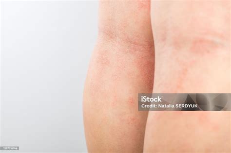 Alergia Atras Do Joelho - Foto de Dermatite Atópica Aguda Nas Pernas Atrás Dos Joelhos De Uma ...
