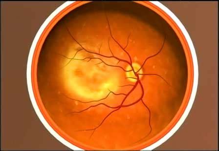 Waverley Eye Clinic Age Related Macular Degeneration - Waverley Eye Clinic