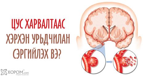 Цус харвалтаас хэрхэн урьдчилан сэргийлж таслан зогсоох вэ?