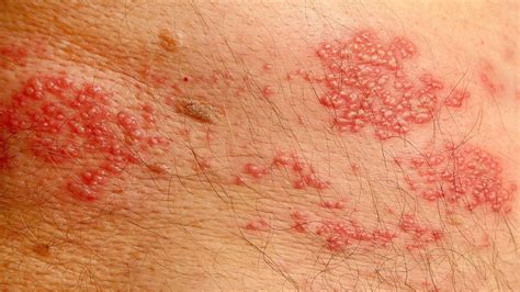 Rashes On Back