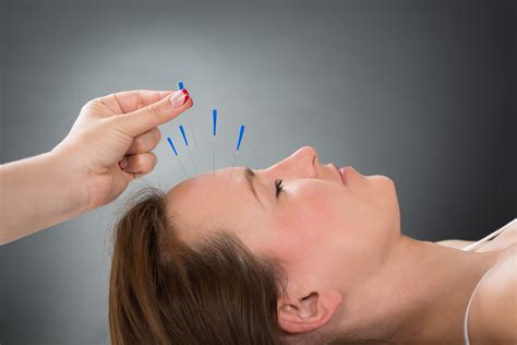 Acupuncture Helpful for Acute, Preventive Treatment of Migraine but ...