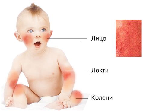 Атопический дерматит у детей: проявление и лечение
