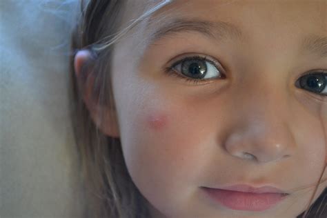 Mosquito Bites On Forehead