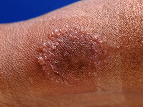 Images Of Ring Worm
