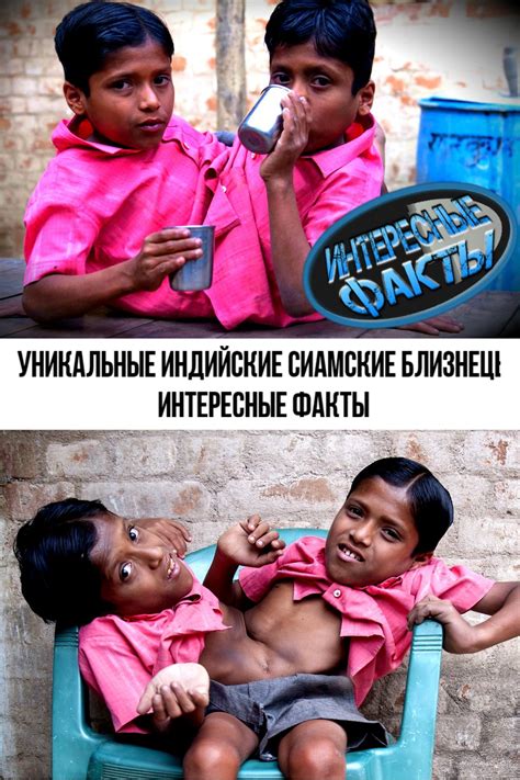 Уникальные Индийские Сиамские БЛИЗНЕЦЫ | Интересные ФАКТЫ | Сиамские ...