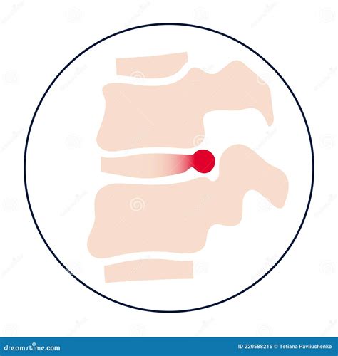Backbone Intervertebral Disc Anatomy Stock Photography | CartoonDealer