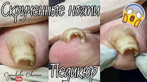 Скрученные ногти на ногах. Классический педикюр, обработка пальцев ног ...