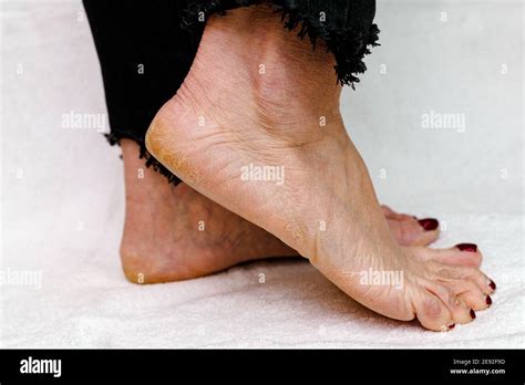 Dry cracked skin woman feet hi-res stock photography and images - Alamy
