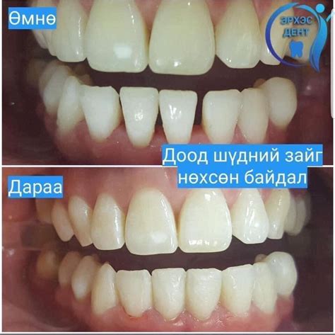 ШҮД - 👩‍⚕️Шүдний зай нөхөх эмчилгээ 👈Шүдний зай үүсэх...