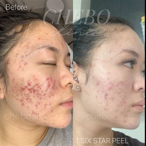 kp treatment for face