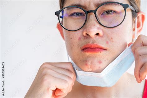 Asian woman worry about acne occur on her face after wearing mask for long time during covid-19 ...