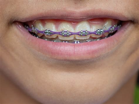 How Long Does It Take For Braces To Straighten Teeth? - General and ...