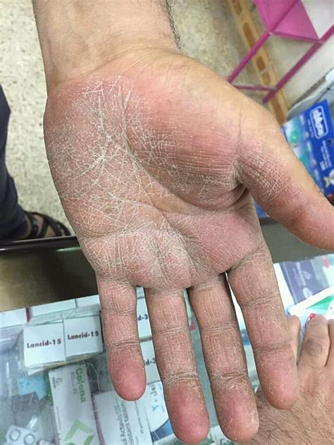 tinea manuum wikiprojectmed