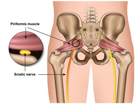 Piriformis Syndrome - USA Spine Care - Laser Spine Surgery