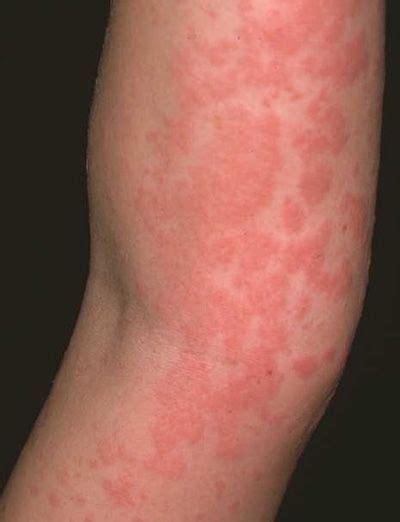 Alergia al Marisco | Gluten allergies symptoms, Gluten allergy, Skin ...