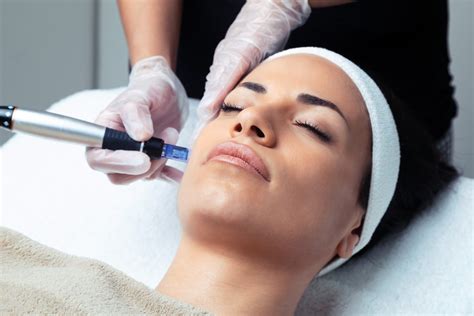 Microneedling – CACE – Cursos Online, Presencial y Trainings en ...