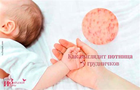 Потница у детей. Как выглядит. Фото. Как лечить потницу