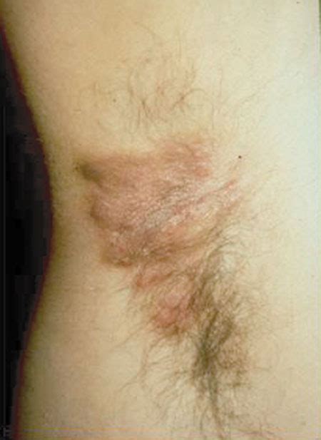 HIV/AIDS Dermatological Images - HIV