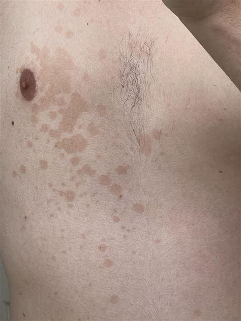 What is this on my chest? Also on my groin. : r/Dermatology