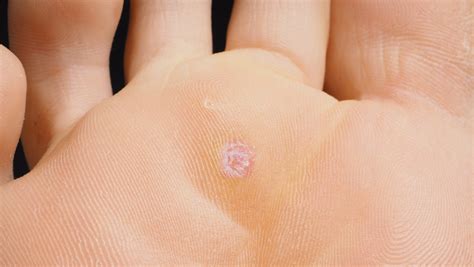 How to get rid of verruca (busting the myths!) - West Berkshire Foot Clinic