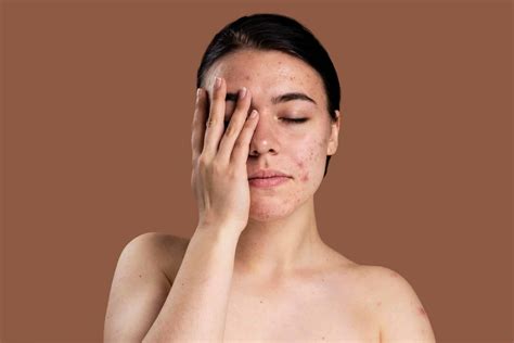 Biotin: A direct Cause or a Cure for Acne? - NUNC