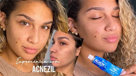 Acnezil Gel Antes E Depois