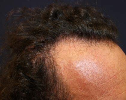 Patient #4790 Follicular Unit Extraction Before and After Photos La ...