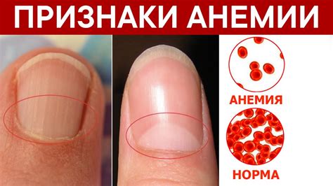 У половины населения АНЕМИЯ, но они не знают признаки анемии и о ...