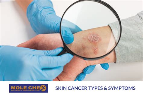 Spotlight on Skin Cancer Procedures: A Precise Approach to Skin Cancer ...