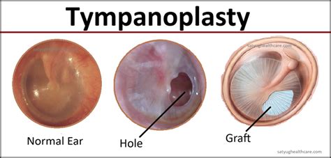 tympanoplasty surgery cost  india