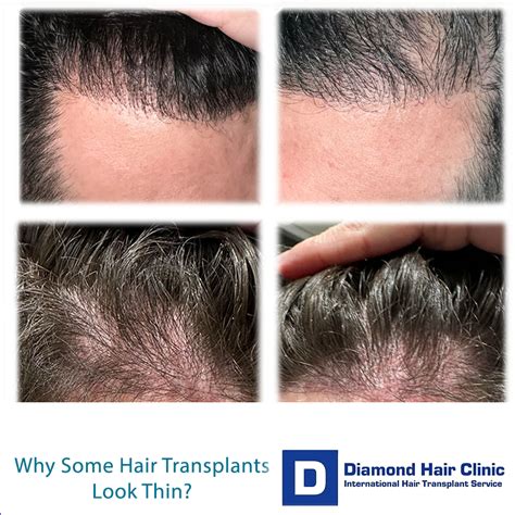 thin hair transplant results