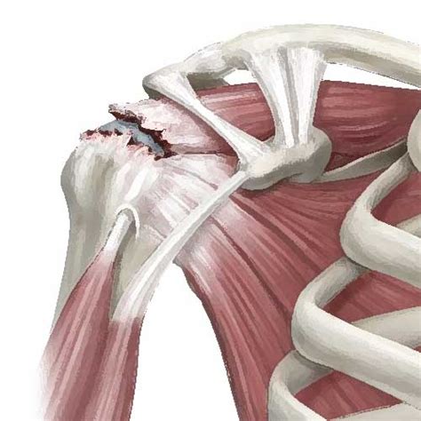 adelaide rotator cuff surgery dr arthur turow shoulder surgeon