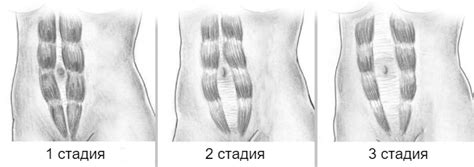 Диастаз живота у мужчин: симптомы и лечение расхождения прямых мышц