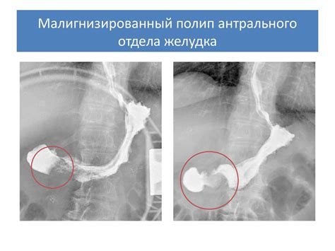 Рак желудка - презентация онлайн