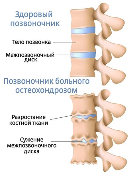 Остеохондроз - виды, симптомы и лечение