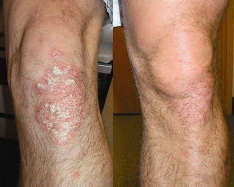 Excimer Laser for Psoriasis in New Jersey | SOMA Skin & Laser