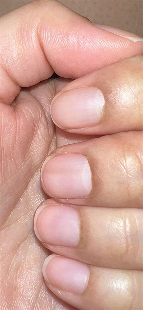 Subungual melanoma? : r/Dermatology