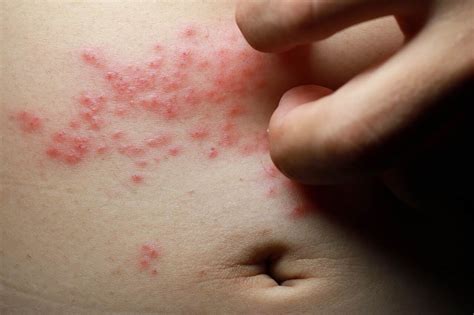 tipos de alergia na pele sintomas causas  tratamentos