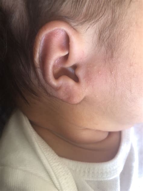 Baby Acne On Ears