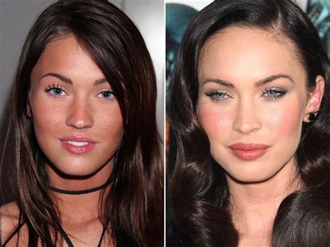 Megan Fox before and after #LipFillersBruising | Celebrity plastic