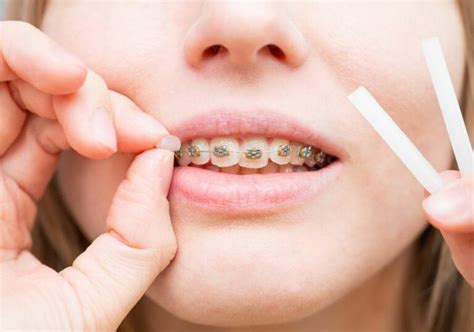 How To Use Dental Wax (A Guide To Applying And Using It）