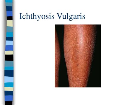PPT - Ichthyosis Vulgaris PowerPoint Presentation, free download - ID ...