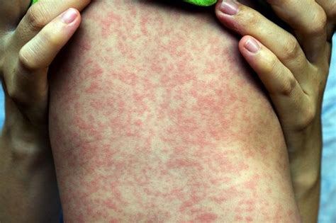 obat campak anak  aman  ampuh atasi gejala alodokter