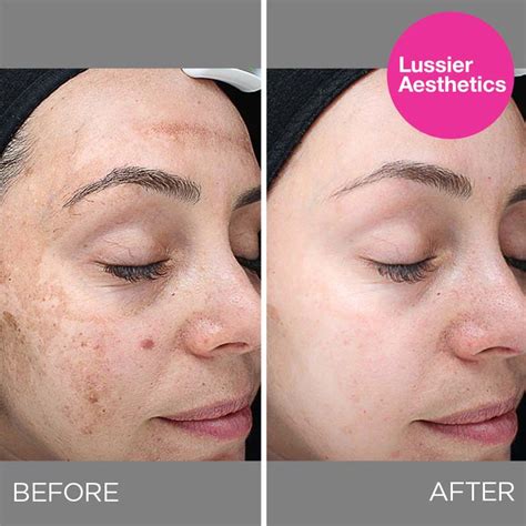 Skin Texture Improvement – Lussier Aesthetics, Inc.