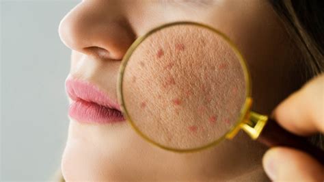 Acne: A Common Skin Condition - Health Channel