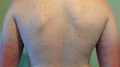 Swimmer's itch notoriously difficult to track, researcher says | CBC News