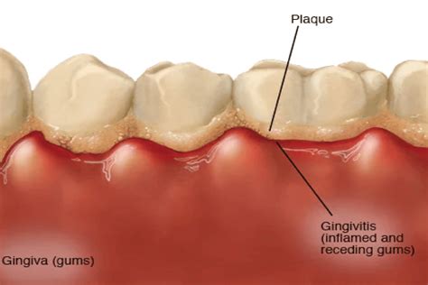 early gingivitis gum disease treatment woodbridge va woodbridge