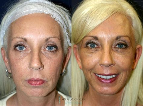 facial fat transfer    pictures case  kalamazoo
